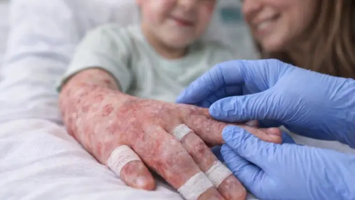 Cura mano enfermedad piel de mariposa Cura piel de mariposa