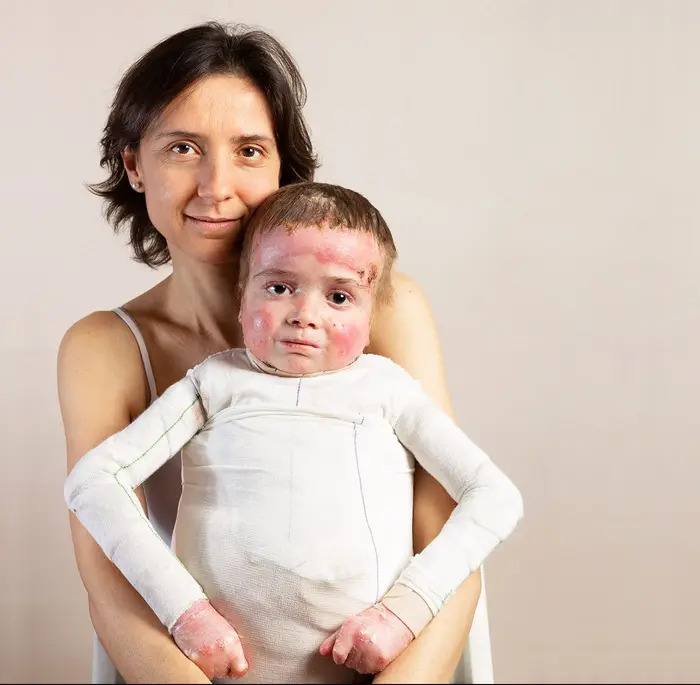 Niño con enfermedad rara piel de mariposa Niño con piel de mariposa